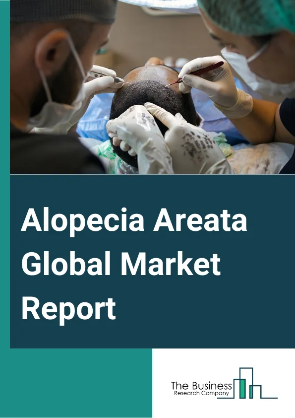 Alopecia Areata Global Market Report 2025 – By Type (Patchy Alopecia Areata, Alopecia Totalis, Alopecia Universalis, Diffuse Alopecia Areata, Ophiasis Alopecia, Other Types), By Treatment (Medical Treatments, Natural Treatment, Other Treatments), By Diagnosis (Trichoscopy, Skin Biopsy, Other Diagnoses), By Route Of Administration (Oral, Topical, Parenteral, Other Routes Of Administration), By End-Users (Hospitals, Specialty Clinics, Homecare, Other End-Users) – Market Size, Trends, And Global Forecast 2025-2034