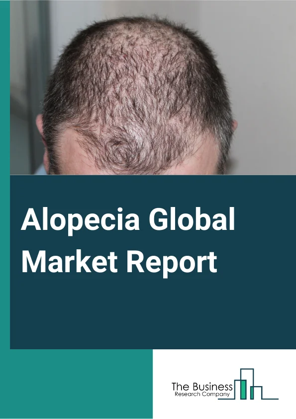 Alopecia Global Market Report 2025 – By Type (Alopecia Areata, Androgenetic Alopecia, Alopecia Totalis, Traction Alopecia, Cicatricial Alopecia, Other Types), By Treatment (Pharmaceutical, Low Level Laser Therapy (LLLT) Devices, Hair Transplant, Regenerative Medicine, Other Treatments), By Gender (Male, Female), By Distribution Channel (Hospital Pharmacies, Retail Pharmacies, Online Pharmacies, Other Distribution Channels), By End-User (Dermatology Clinics, Homecare Settings, Other End-Users) – Impact of Tariff and Trade War on Market Size, Growth, Trends, and Forecast 2025–2034