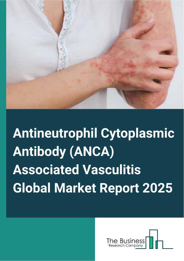 Global Antineutrophil Cytoplasmic Antibody (ANCA) Associated Vasculitis Market Report 2025