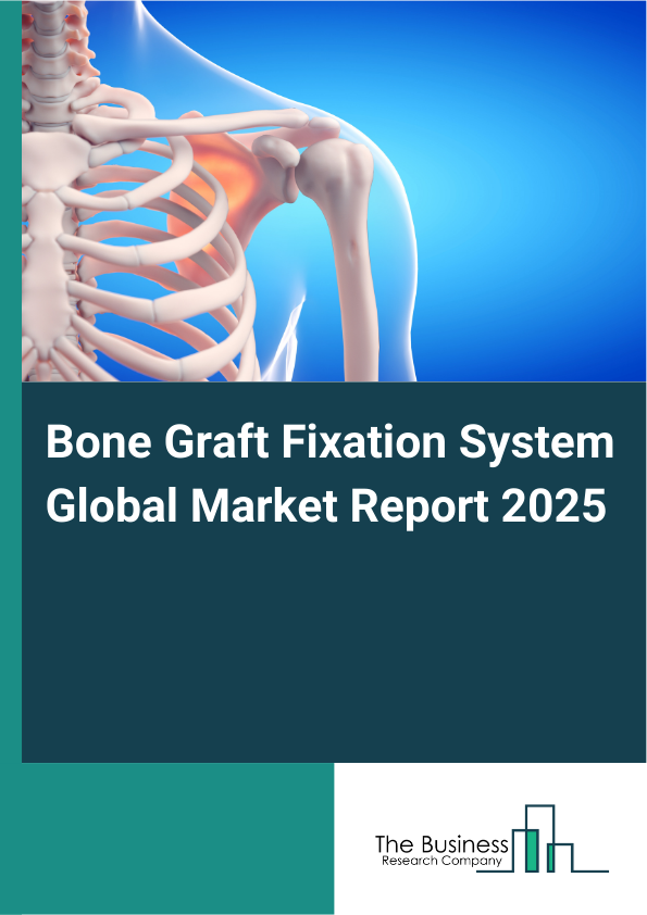 Global Bone Graft Fixation System Market Report 2025