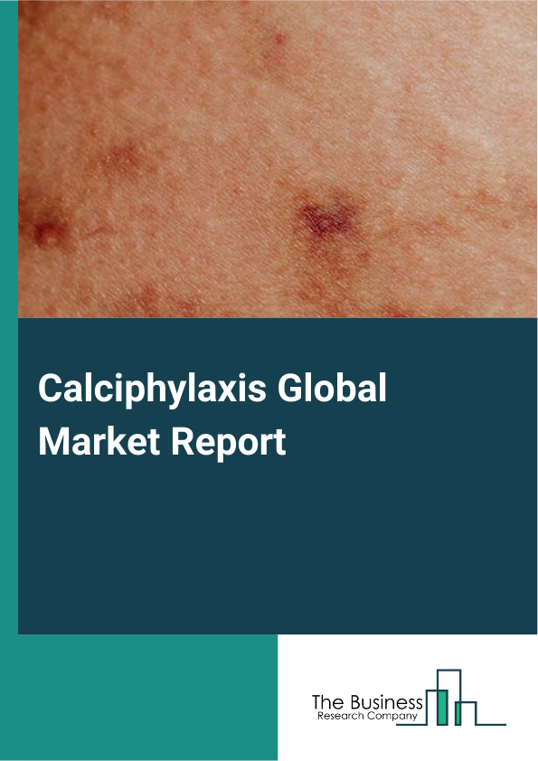 Calciphylaxis Global Market Report 2025 – By Type (Non-Uremic Calciphylaxis, Ulcers And Wounds, Debridement Of Wounds), By Treatment (Drug Therapy, Hyperbaric Calciphylaxis Therapy), By Diagnosis (Deep Skin Biopsies, Blo...