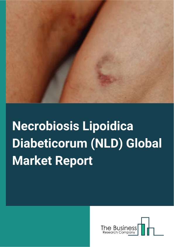 Global Necrobiosis Lipoidica Diabeticorum (NLD) Market Report 2025 