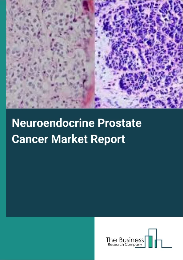 Neuroendocrine Prostate Cancer Market Report Infographic Image
