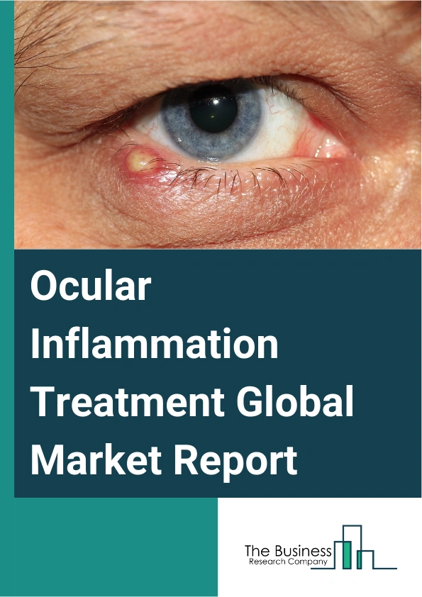 Ocular Inflammation Treatment Global Market Report 2025 – By Treatment Type (Immunosuppressant, Antivirals, Corticosteroids, Antibiotics, Analgesics, Monoclonal Antibodies, Antifungal, Cycloplegic), By Mode of Operation ...