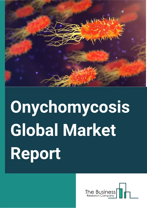 Onychomycosis Global Market Report 2025 – By Type (Distal Subungual Onychomycosis (DSO), White Superficial Onychomycosis (WSO), Proximal Subungual Onychomycosis (PSO), Candida Onychomycosis, Other Types), By Treatment (Drug Treatment, Topical Therapy, Other Treatments), By Distribution Channel (Hospitals Pharmacies, Retail Pharmacies, Other Distribution Channels) – Market Size, Trends, And Global Forecast 2025-2034